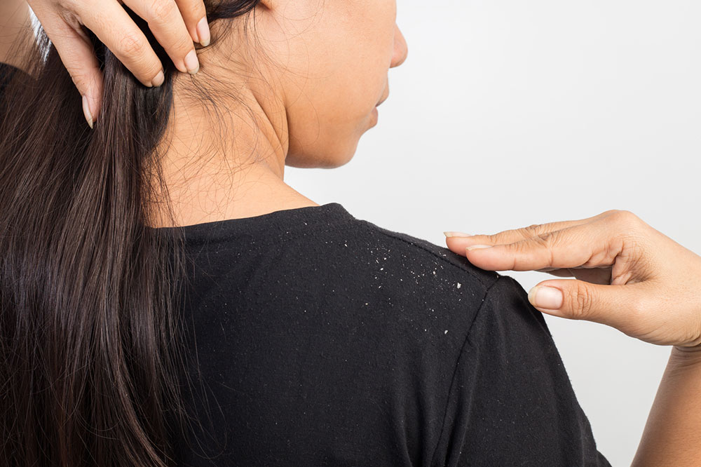 4 Natural Remedies for Dandruff