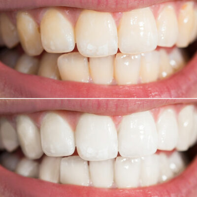 Top 6 Ways to Whiten Teeth at Home