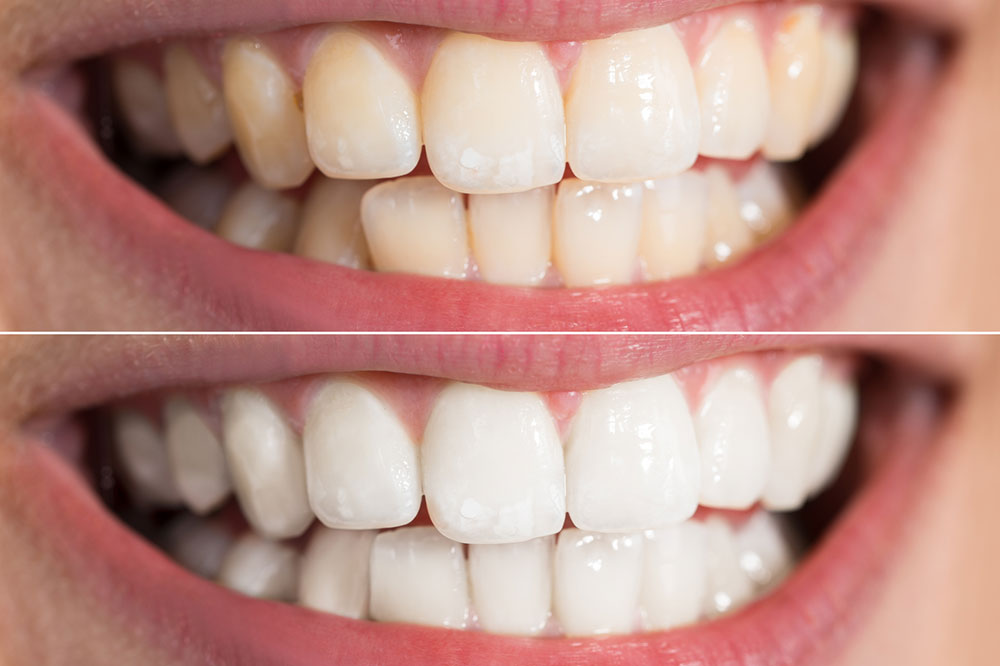 Top 6 Ways to Whiten Teeth at Home