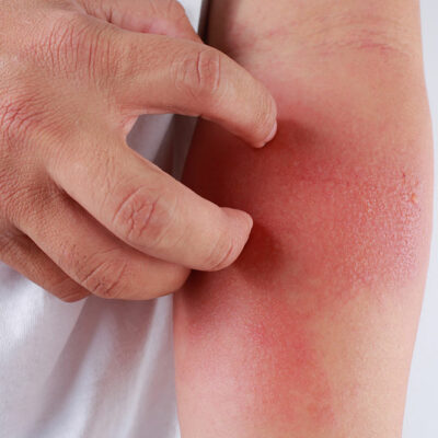 The Worst Cities to Live for Eczema Patients