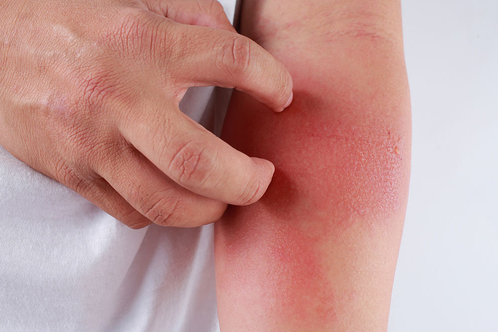 The Worst Cities to Live for Eczema Patients